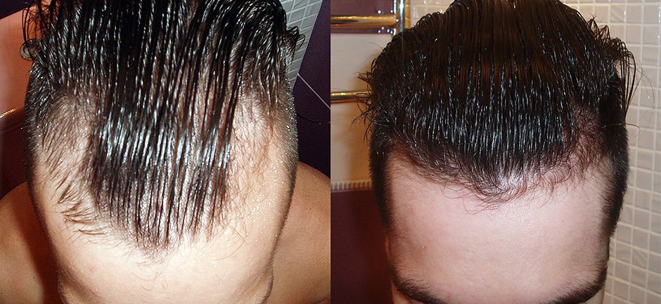 Как восстановить волосяные луковицы на голове в домашних условиях мужчине