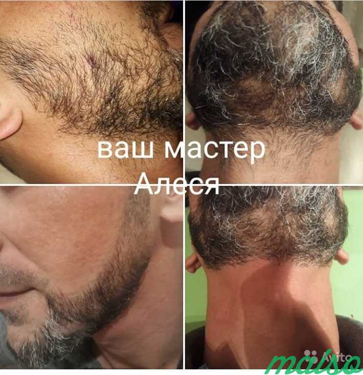Лазерная эпиляция для мужчин - процедура удаления волос на спине, бороде и бикини