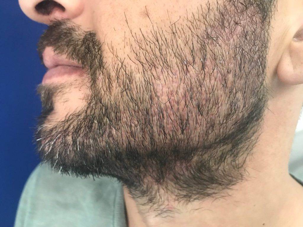 Не растет борода на щеках: возможные причины