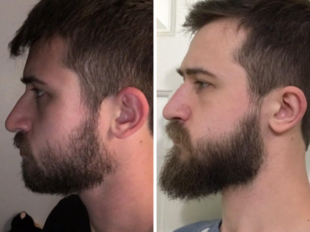 Как сделать чтобы борода росла гуще и ровнее?