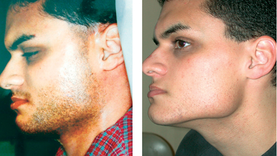 Лазерная эпиляция бороды у мужчин: удаление волос надолго