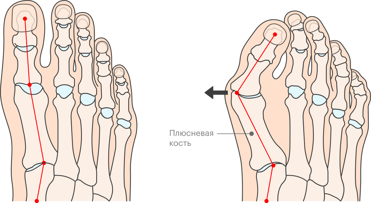 Вальгус кость. Через какие точки проходят линии при определении углов hallux valgus. Kopf hand Fuss kinderkranheir что это.